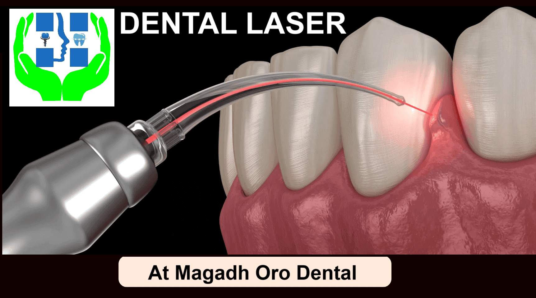 Gum Disease Treatment & Laser Gum Therapy in Patna – Complete Guide