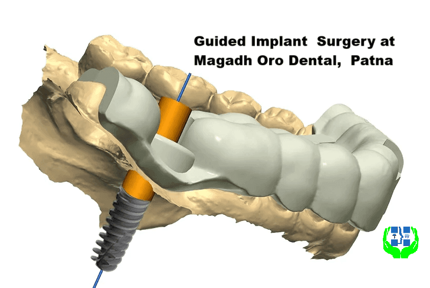 Guided Implant Surgery & Full Mouth Rehabilitation in Patna 