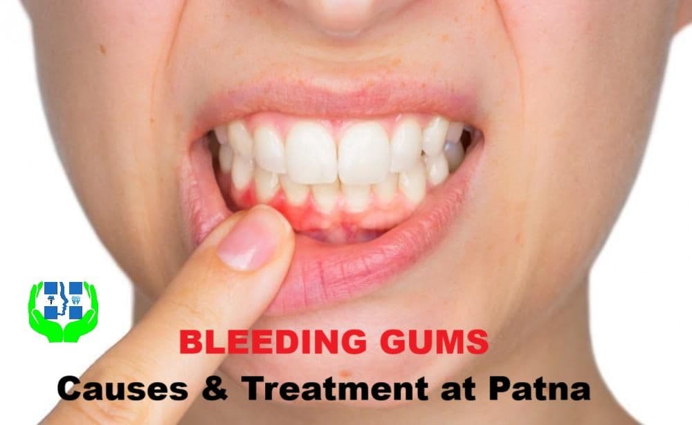 Bleeding Gums: Causes, Treatment, and Cost in Patna | Magadh Oro Dental Clinic