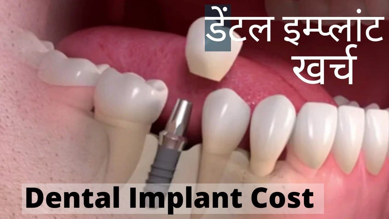 Understanding Dental Implant Costs: What to Expect and How to Plan