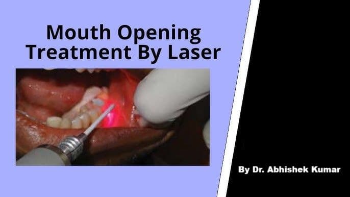 Oral Submucous Fibrosis (OSMF) Treatment in Patna | Laser Therapy & Cost