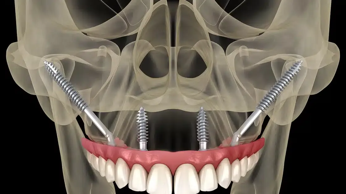 Zygomatic Implants in Patna | Best Dental Implant Clinic | Magadh Oro Dental