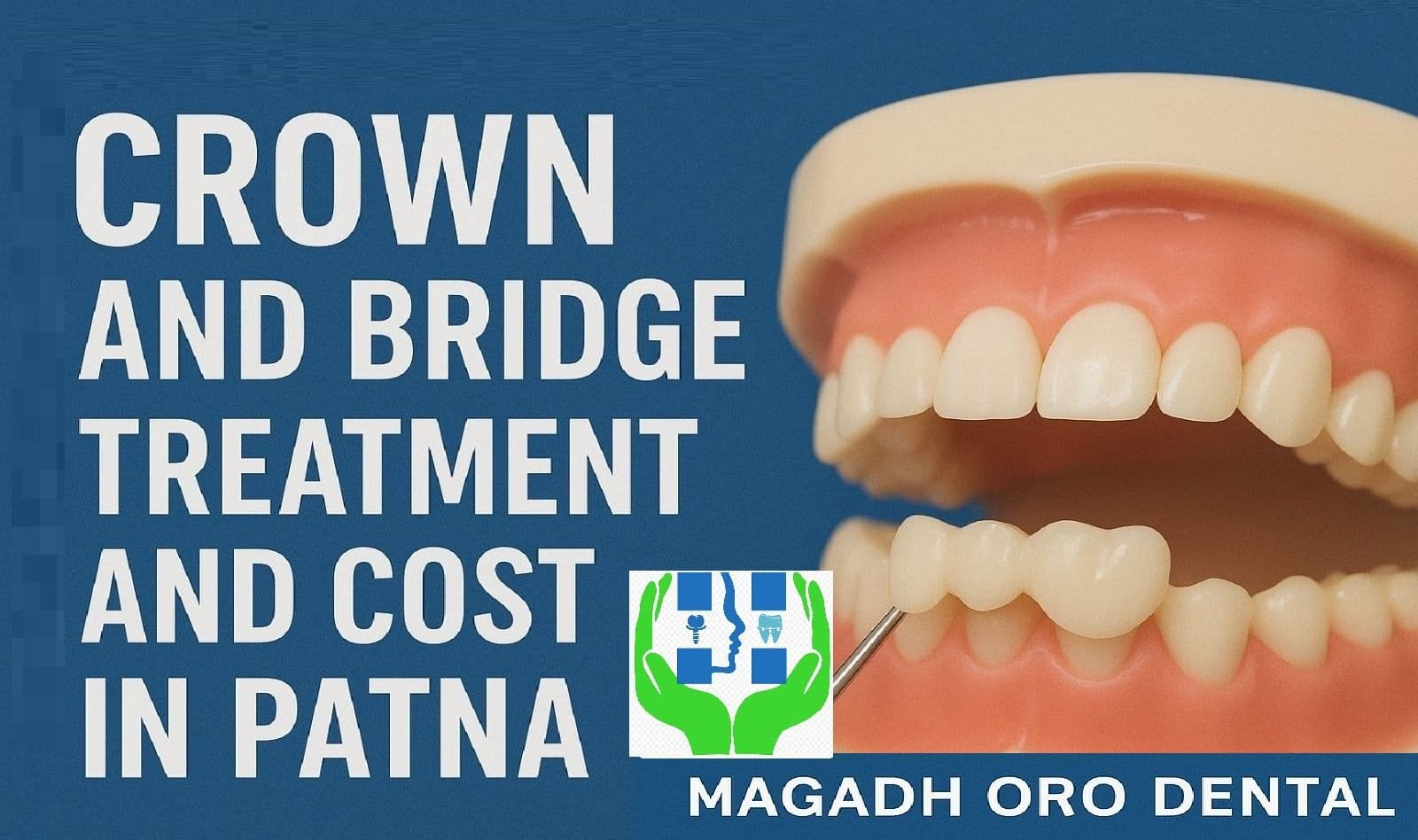 Crowns and Bridges Treatment in Patna – Digital Dental Solutions