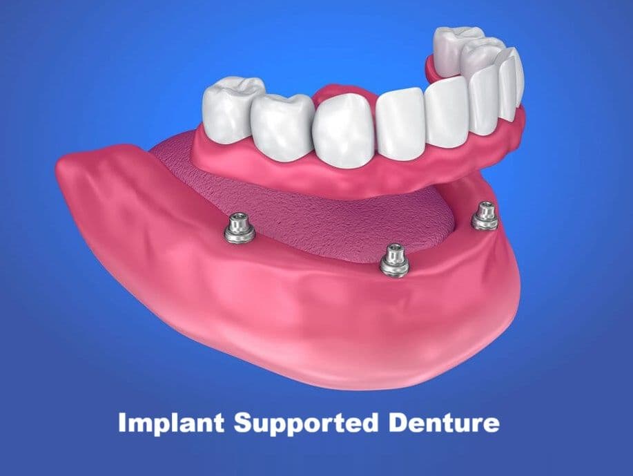 Implant Supported Dentures: Process, Benefits & Cost in Patna | Dr. Abhishek Kumar