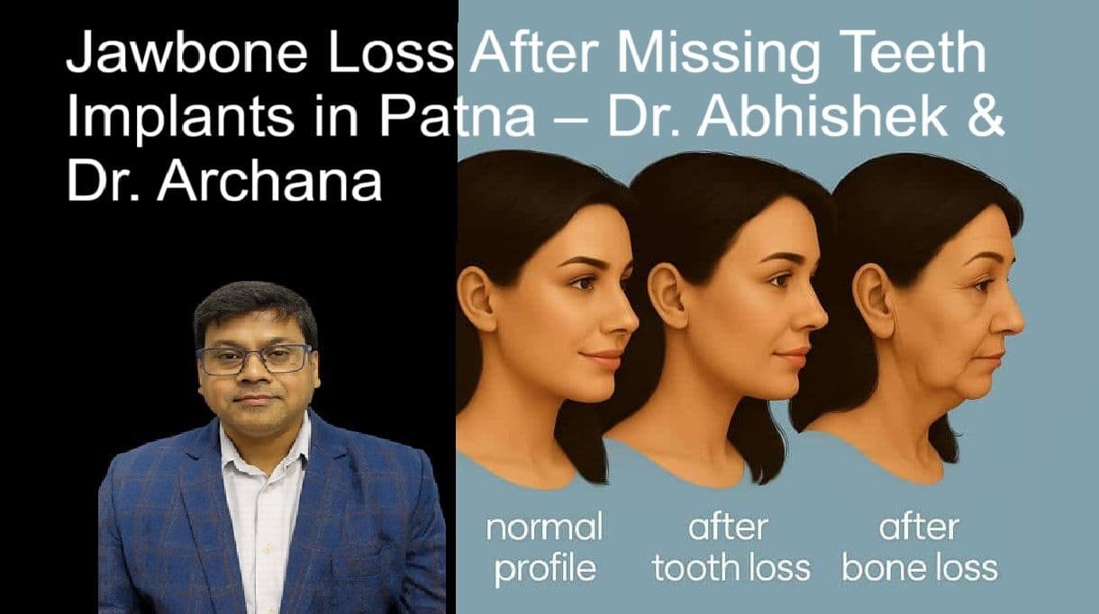 Jawbone Loss After Missing Teeth | Implants in Patna – Dr. Abhishek & Dr. Archana