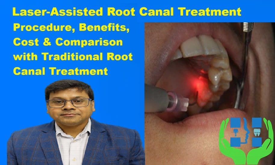 Laser-Assisted Root Canal Treatment : Procedure, Benefits, Cost & Comparison with Traditional Root Canal Treatment | Dr. Abhishek Kumar
