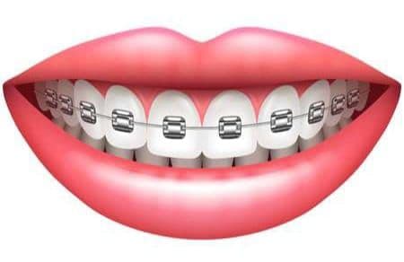 Orthodontic Treatment in Patna | Magadh Oro Dental