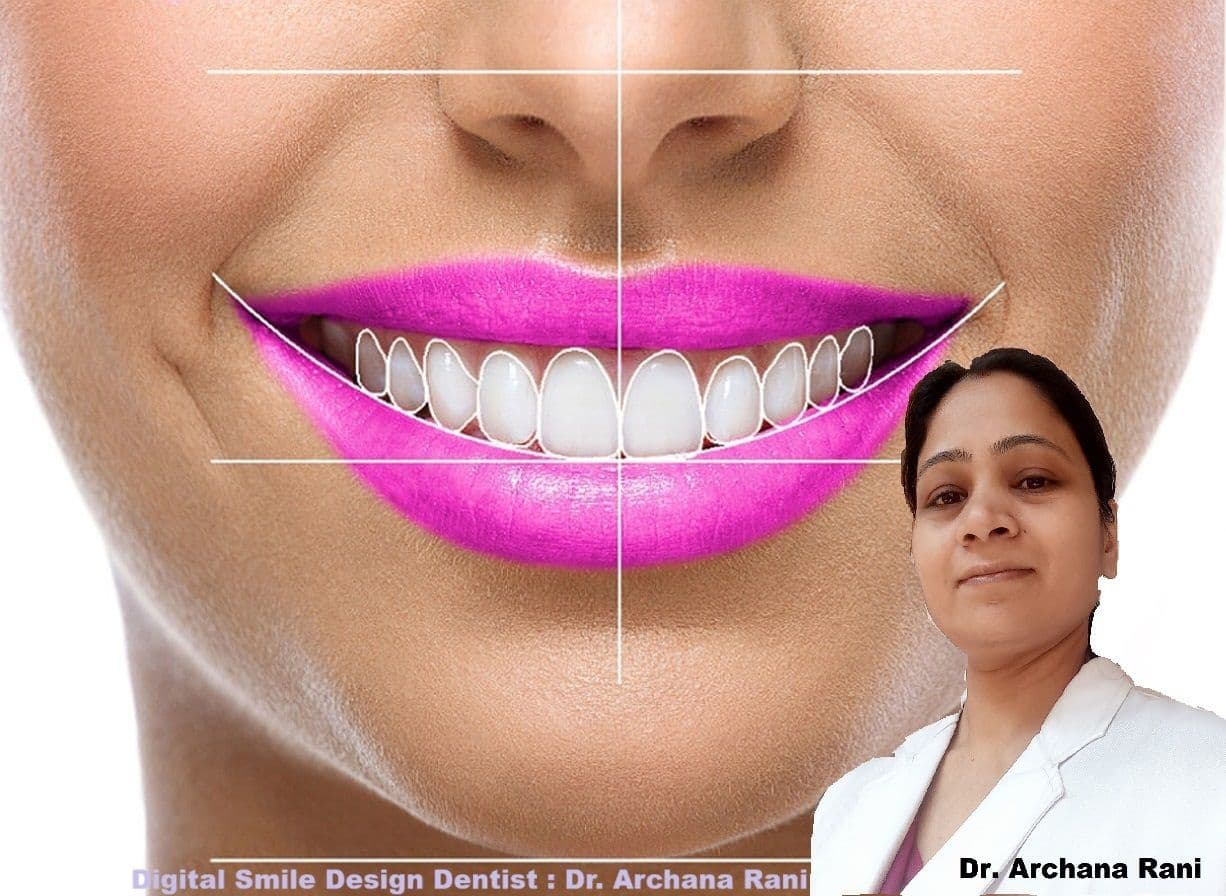 Smile Designing in Patna – Cost, Procedure & Benefits