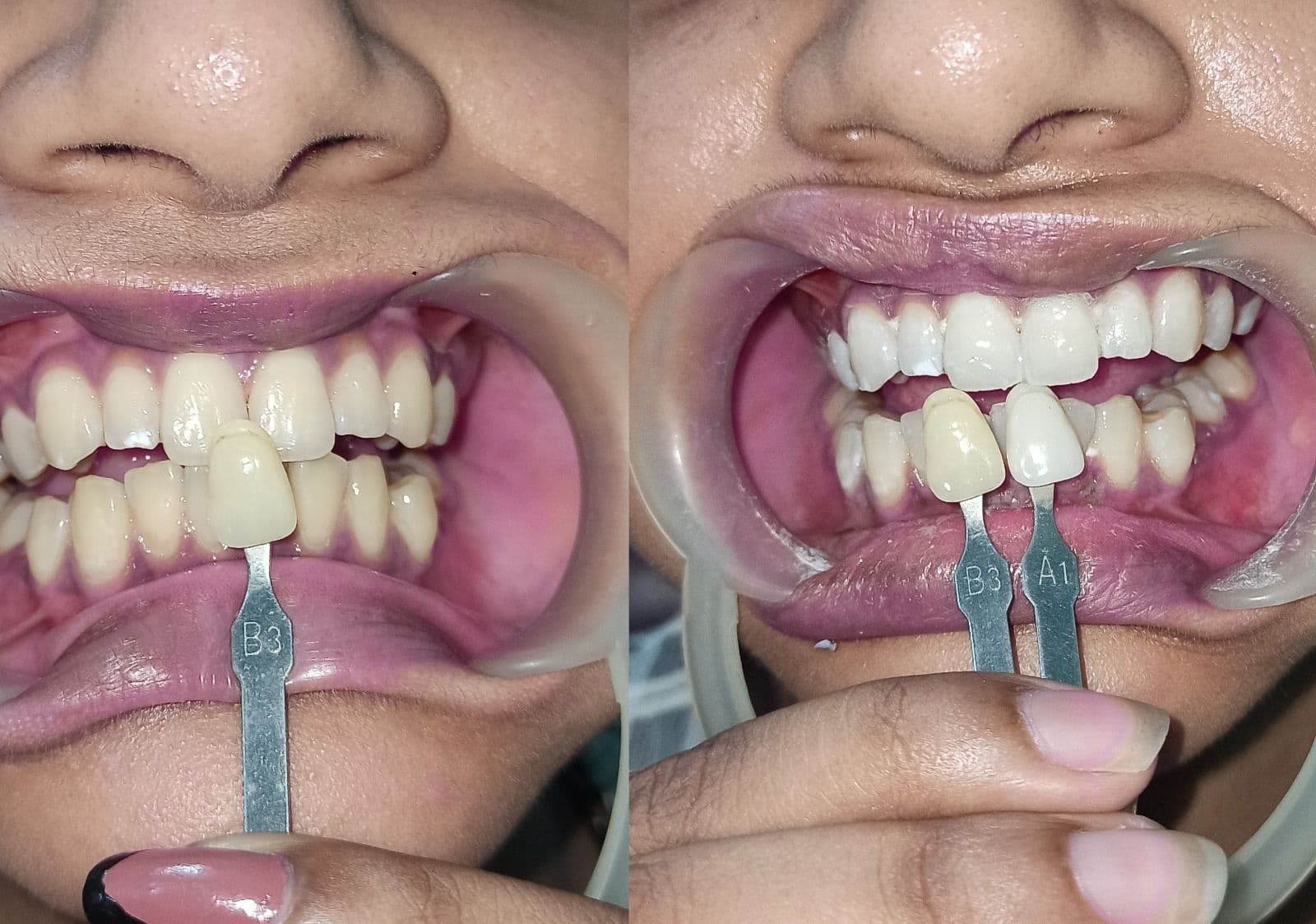 Teeth Whitening by 17 Years experienced cosmetic dentist - Dr. Archana Rani (2).jpeg