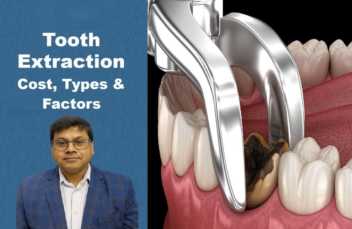 Tooth Extraction in Patna – Cost, Types & Factors | Magadh Oro Dental