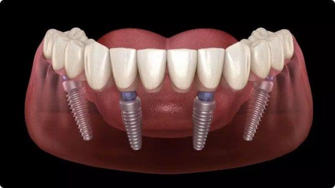 All-on-4 Dental Implants : Procedure, Benefits and Cost in Patna, Bihar