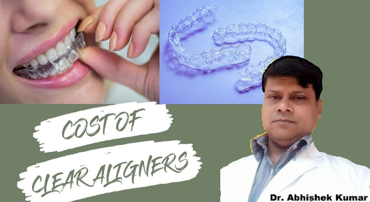Teeth Aligners Cost in Patna | Clear Aligners Cost Breakdown